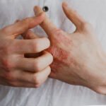 Atopic Dermatitis – All You Need To Know