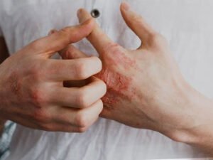 Atopic Dermatitis – All You Need To Know